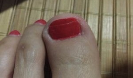 修甲沟炎的视频